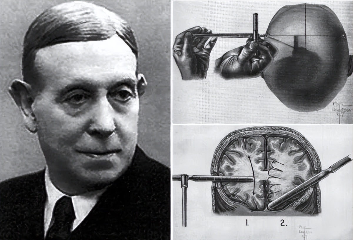 诺贝尔奖前额叶切除术,诺贝尔奖历史完整版