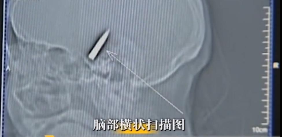 故事:江苏70岁老人头疼欲裂,检查时发现颅内有*弹子**,吓坏在场医生