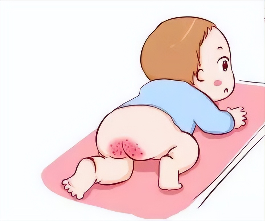 宝宝红屁屁和纸尿裤有关吗,宝宝红屁屁可以用爽身粉吗