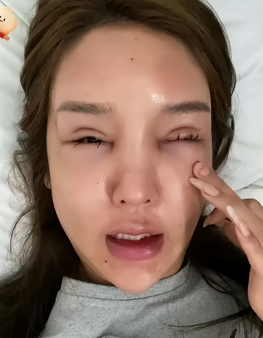 “桃花宝宝”迷恋整容，八年花费上百万，嘴歪眼斜额头出现大坑