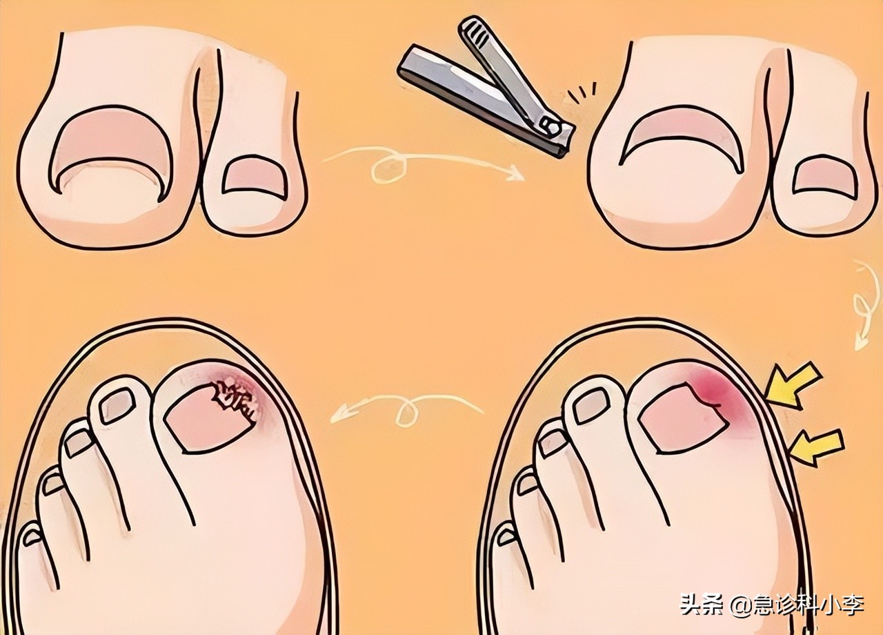 脚趾甲老往肉里钻,脚趾甲总是往肉里钻怎么办