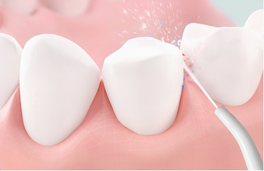 冲牙器的副作用与危害,警惕冲牙器的危害与副作用