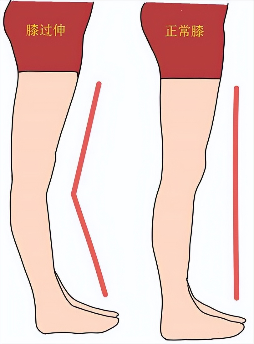 膝关节伸直时咯噔响是怎么回事,膝关节弹响的原因及治疗方法