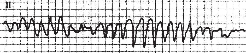 室性心动过速的五步鉴别方法,室性心动过速的诊断标准