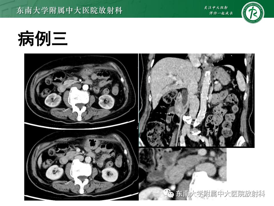 小肠间质瘤最新治疗中药方,小肠间质瘤基因检测