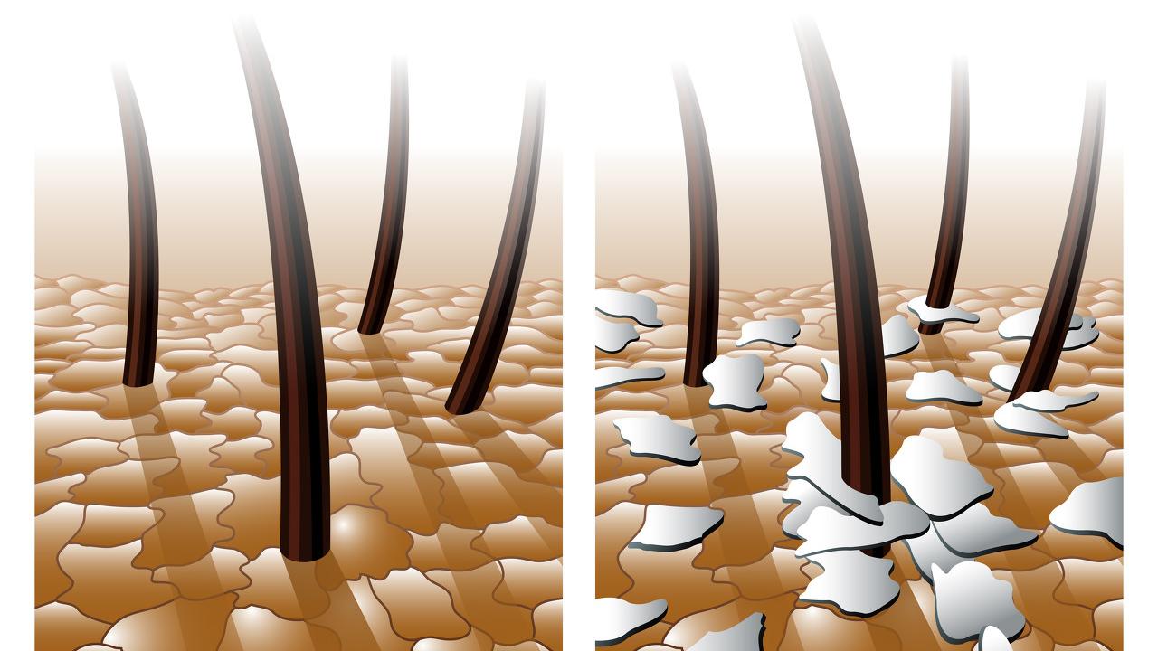 头痒头屑多掉发严重小妙招,治疗头屑头痒脱发的小妙招