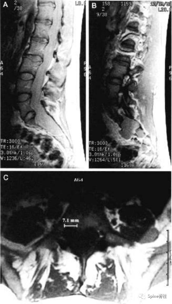 硬膜扩张,duralectasia