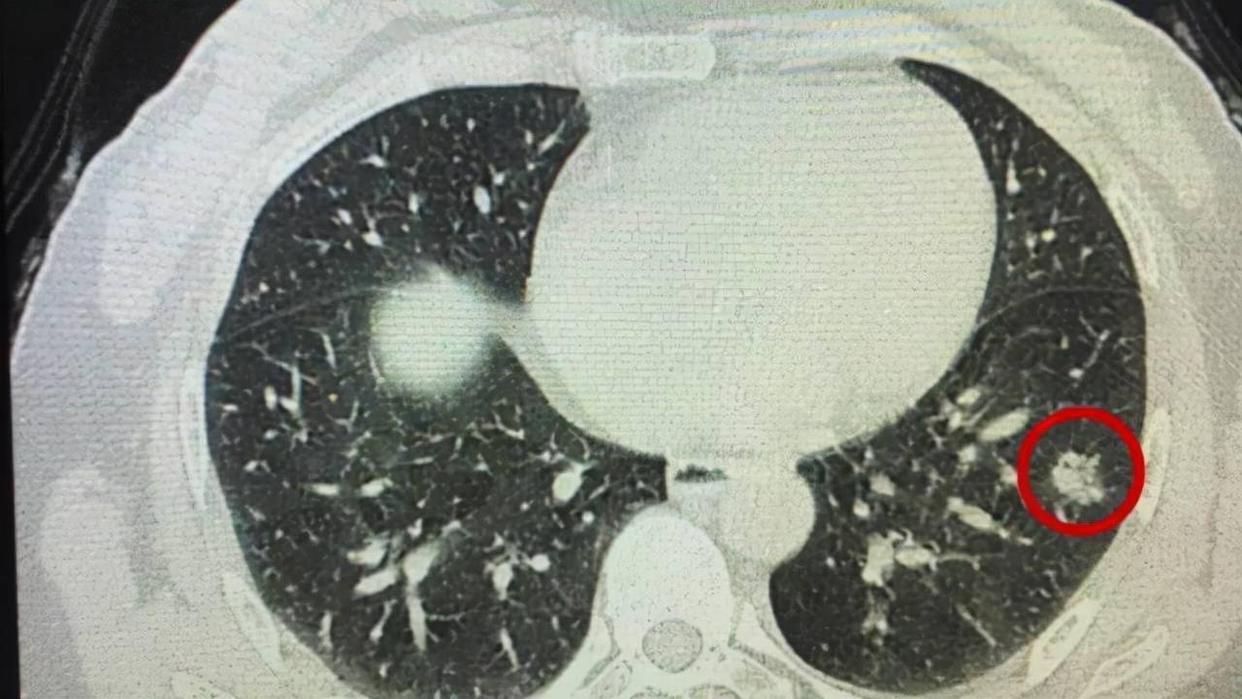 肺结节患者为什么不能吃牛肉,有肺结节的不能吃牛肉吗