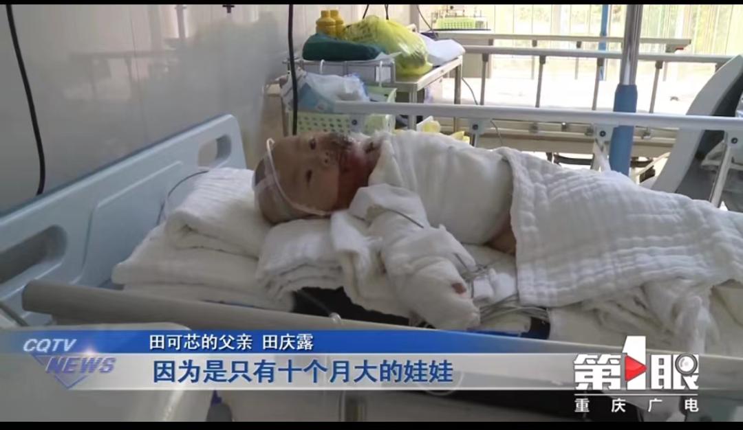 悲痛！女童全身60%烧伤，170万仅能保命！烧伤后到底该怎么做