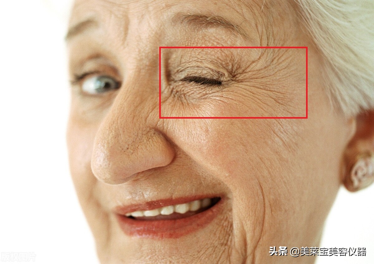 鱼尾纹最显老的一个部位,鸡爪纹和鱼尾纹哪个显老