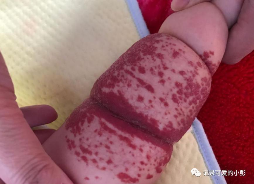 20岁少女产下混血女婴,20岁女子产下胎儿畸形