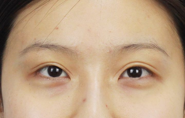 全切双眼皮第十天双眼不对称,双眼皮术后不对称是什么原因