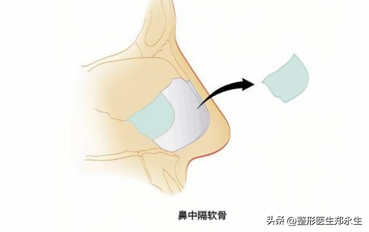 30岁小伙鼻中隔偏曲、鼻甲消融后，鼻梁塌陷嗅觉减退，还有救吗？