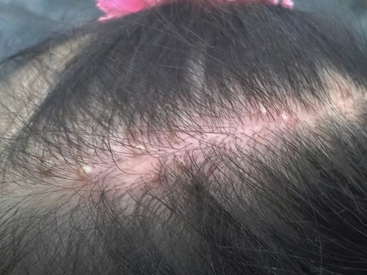 头皮总长小疙瘩和脓包怎么治疗,如何改善头皮长脓包和疙瘩的问题