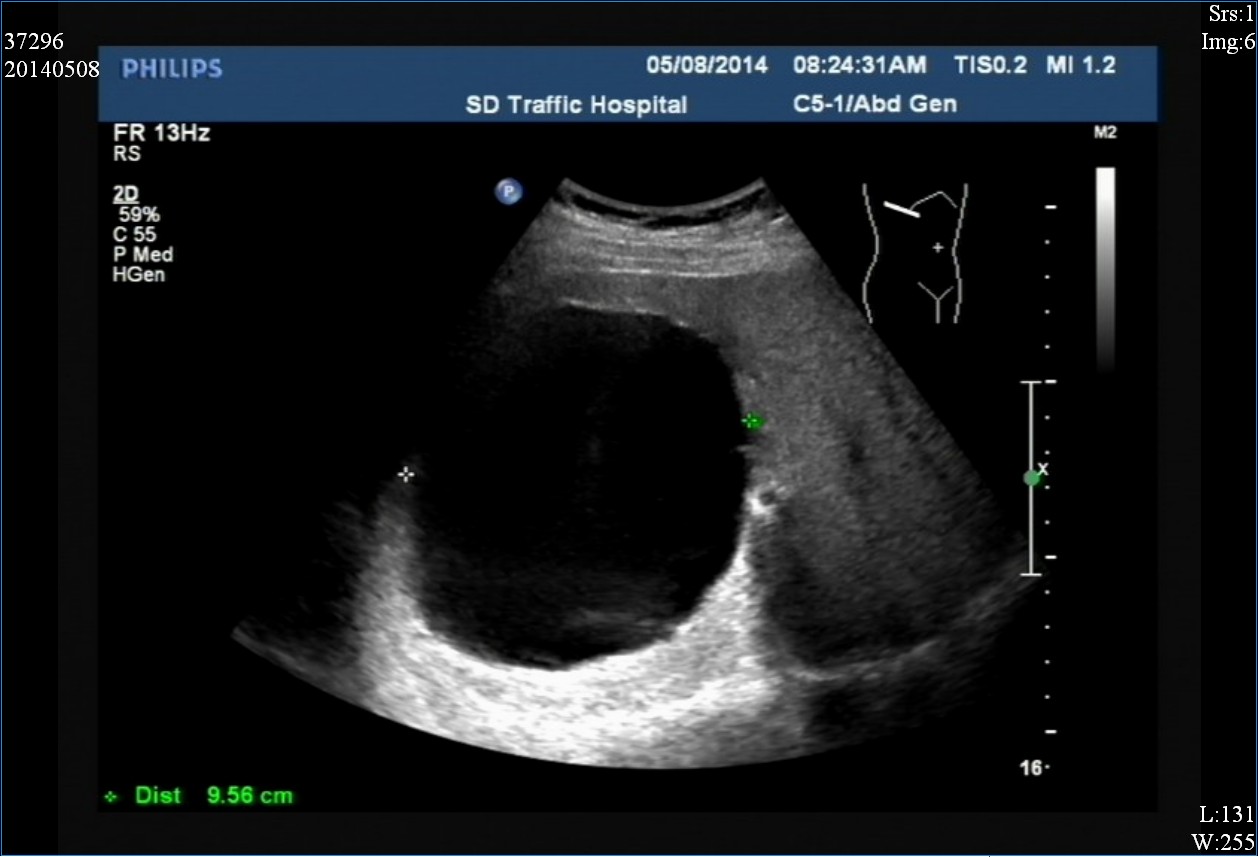 医生说是囊肿是什么意思,已经形成囊肿了怎么消除