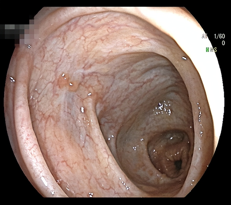 20多岁年轻姑娘，她的肠道竟然是这样的……