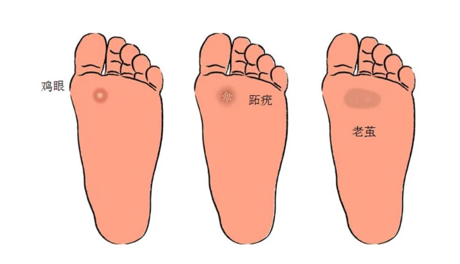 脚底板爱出汗怎么解决,脚底板爱出汗是什么原因造成的