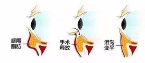 自己怎么修复泪沟,泪沟是消除不了的吗