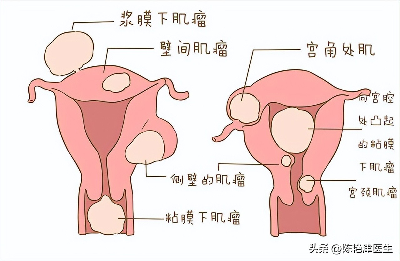 女性为什么容易长子宫肌瘤?提醒:平时尽量避免3个行为,别忽视