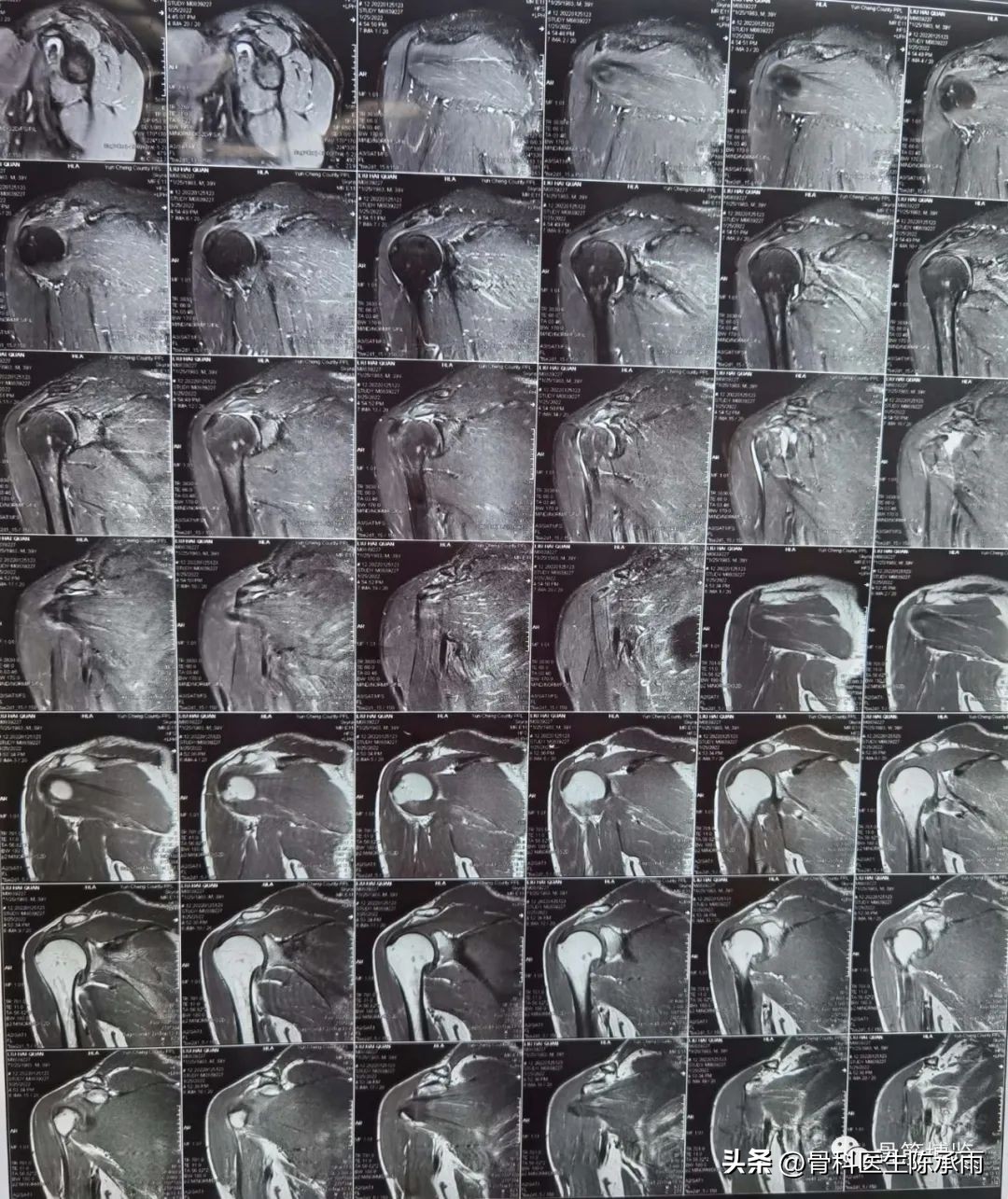 肱二头肌长头肌腱断裂超声报告,上臂肱二头肌