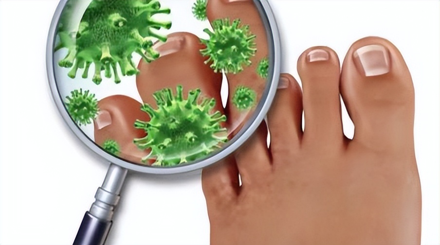真菌感染怎么预防,足部真菌感染怎么解决