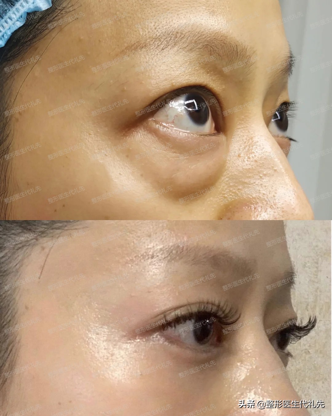 下眼袋下边的皱纹叫什么,下眼袋有皱纹图片