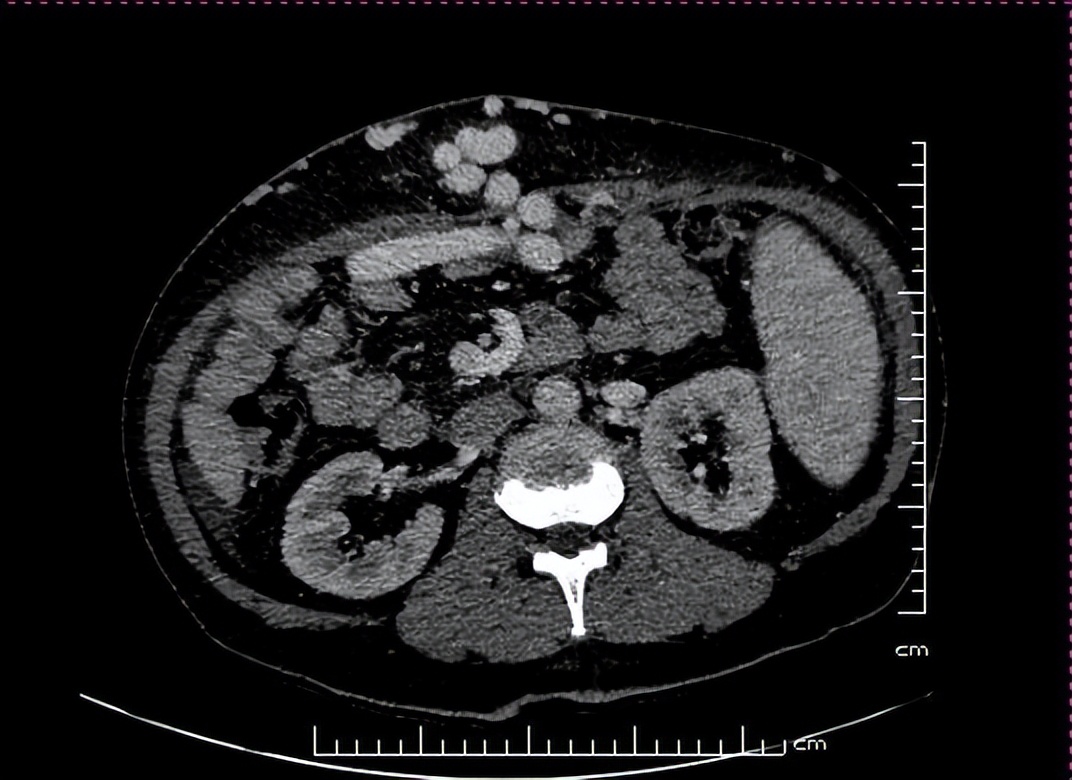 疫情下的生命接力哈医大一院完成疫情期间第三例肝脏移植手术