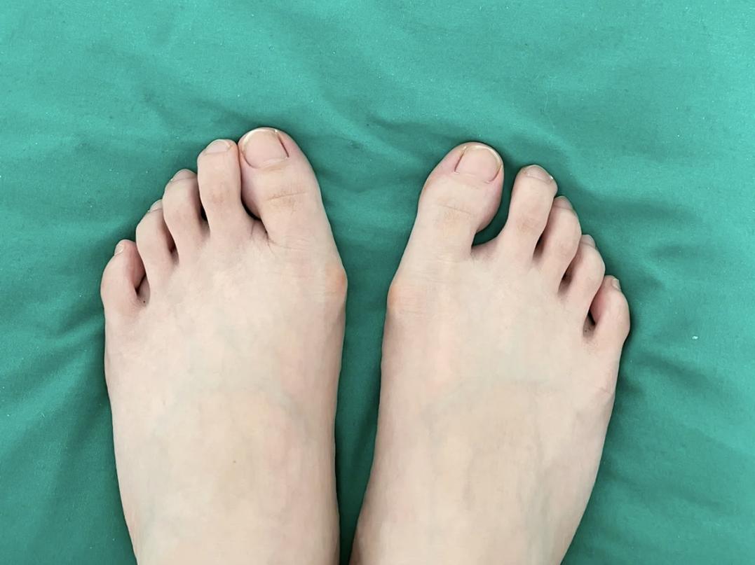 董小姐和老公吵架完整版,拇外翻手术辽宁女孩