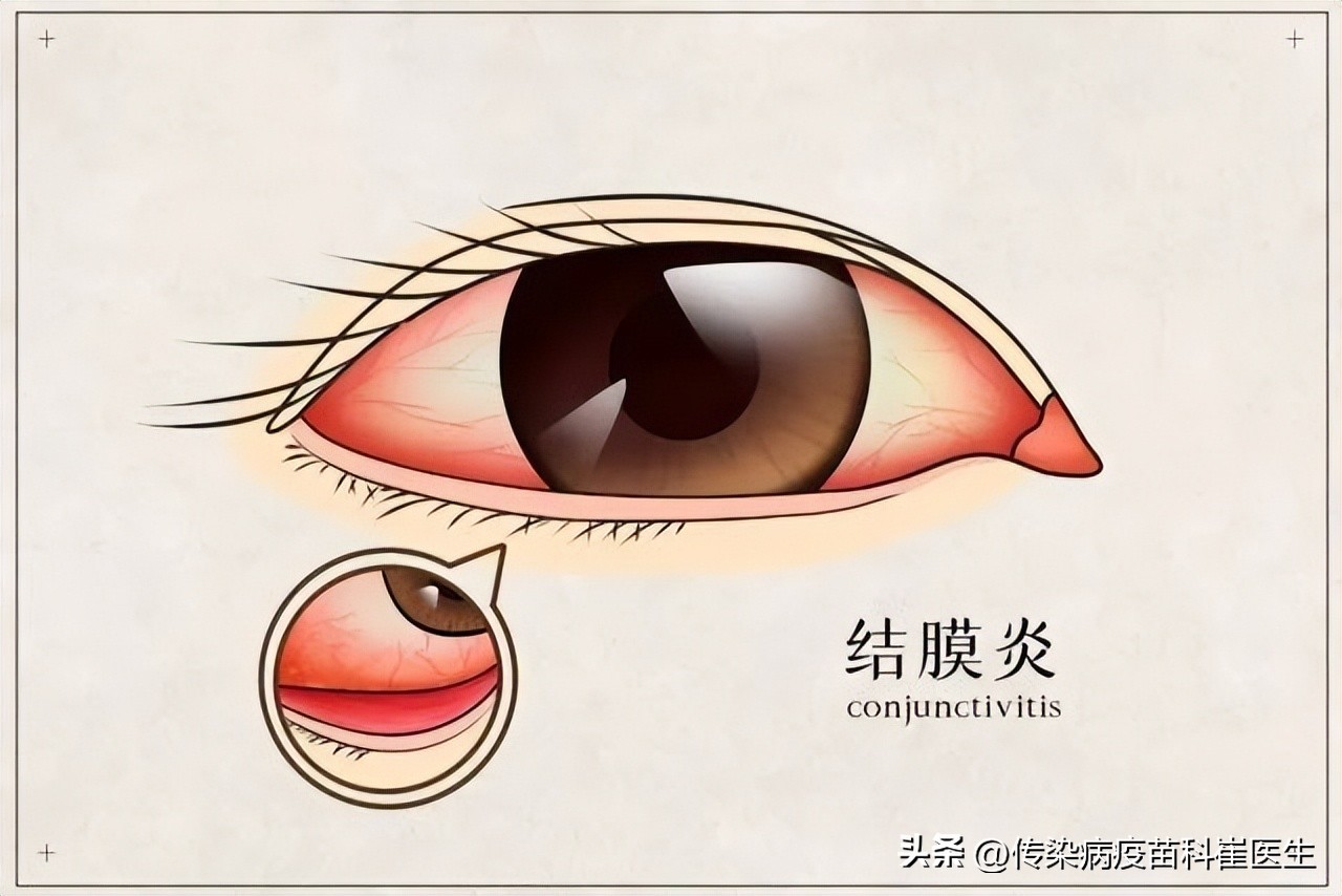 小孩眼睛红怎么办有时红的吓人,孩子眼睛红红的有血丝怎么办