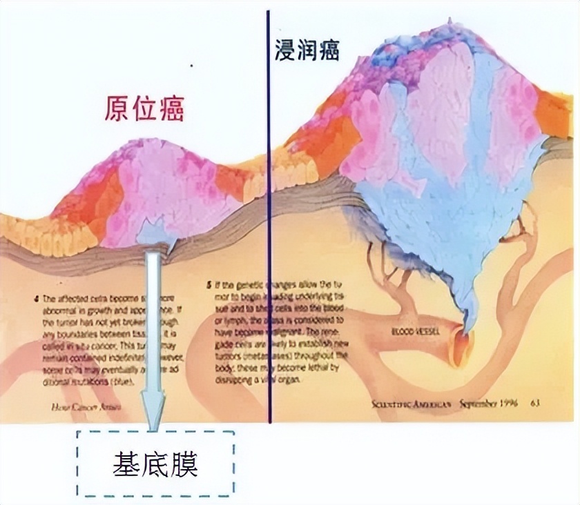 乳腺原位癌是什么？和浸润性癌治疗上有何不同