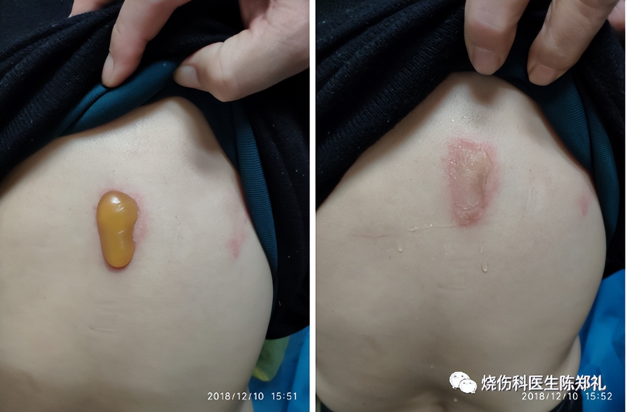 小孩在小餐桌烫伤怎么办,小朋友进厨房被烫伤了