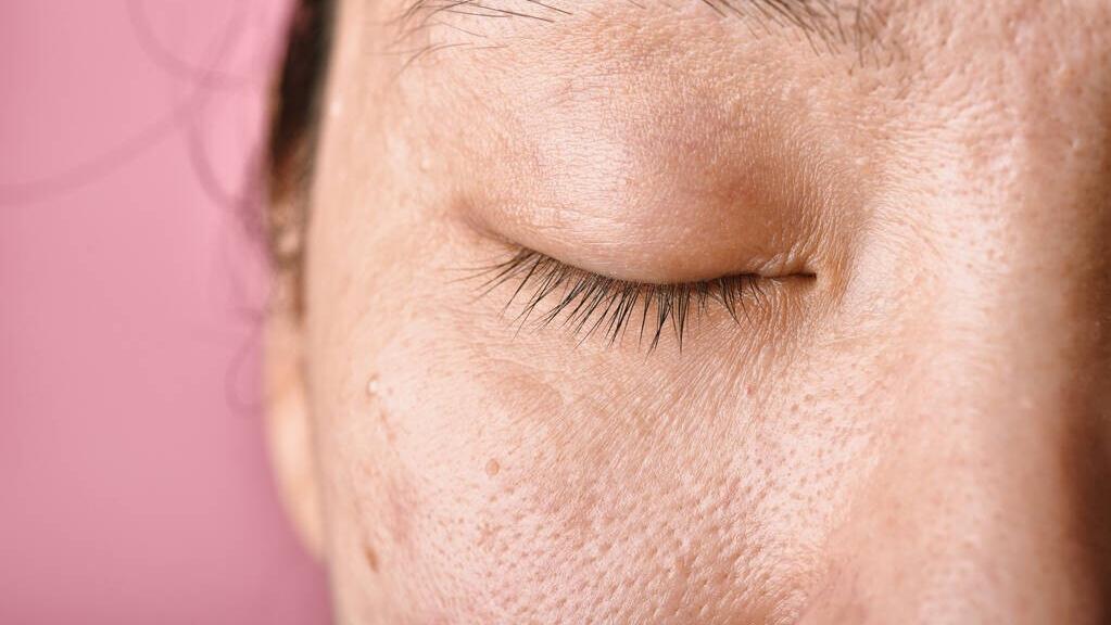 长痘原因是水油不平衡吗,长痘是肤质问题