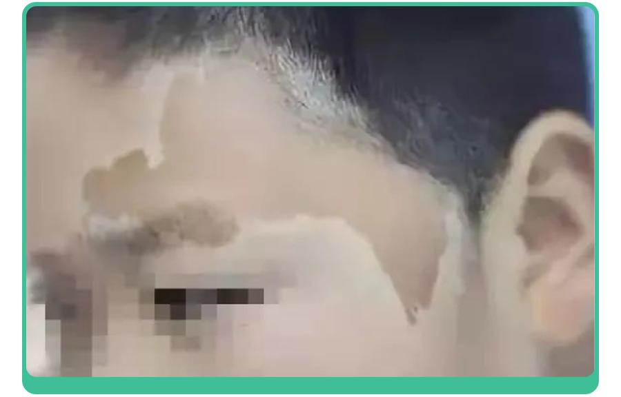 宝宝手上长胎记，一查竟是血管瘤！医生：这5种胎记要早处理