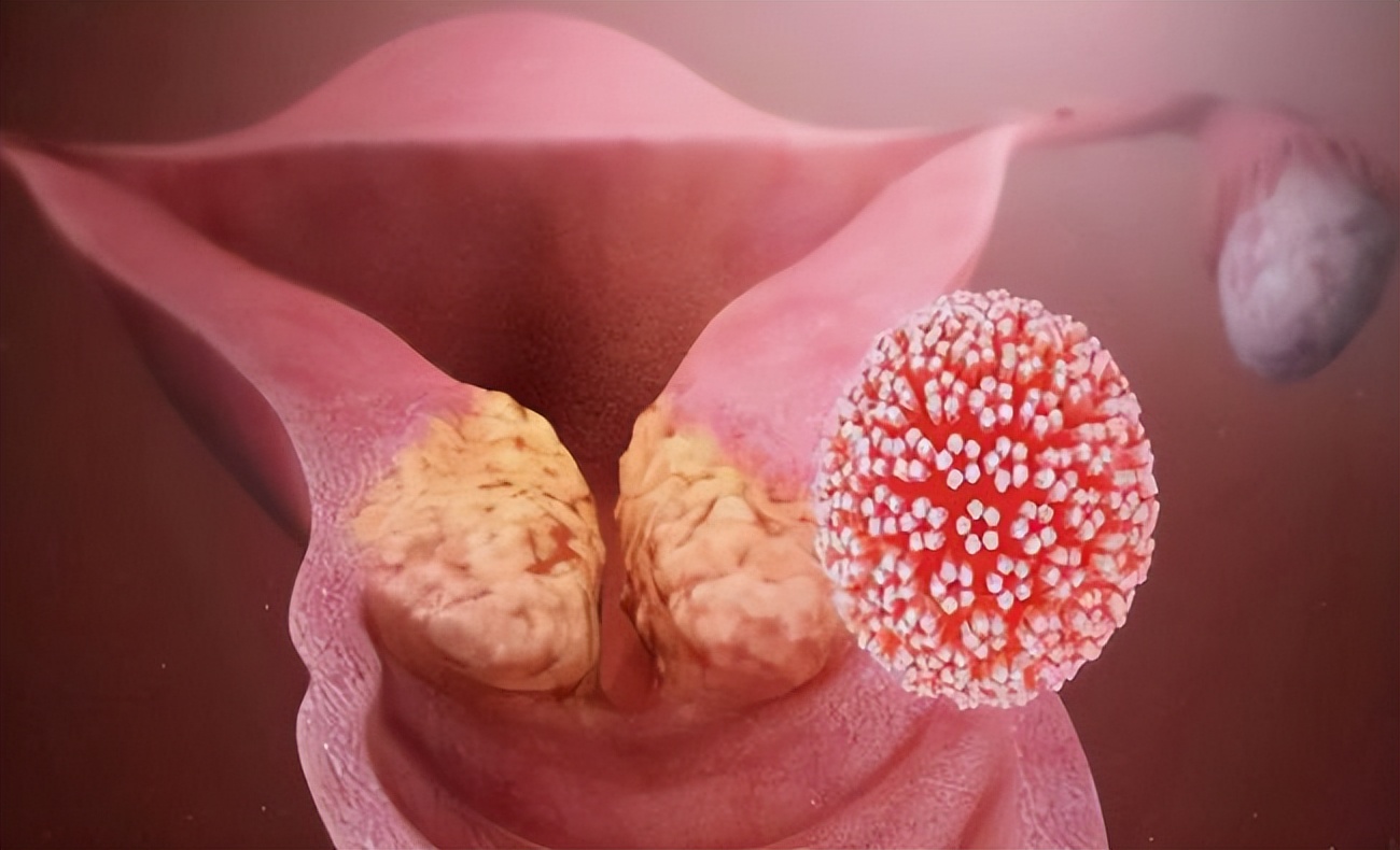 45岁女子感染HPV，3个月*处私**长满“痘痘”！下身4种异常别再轻视