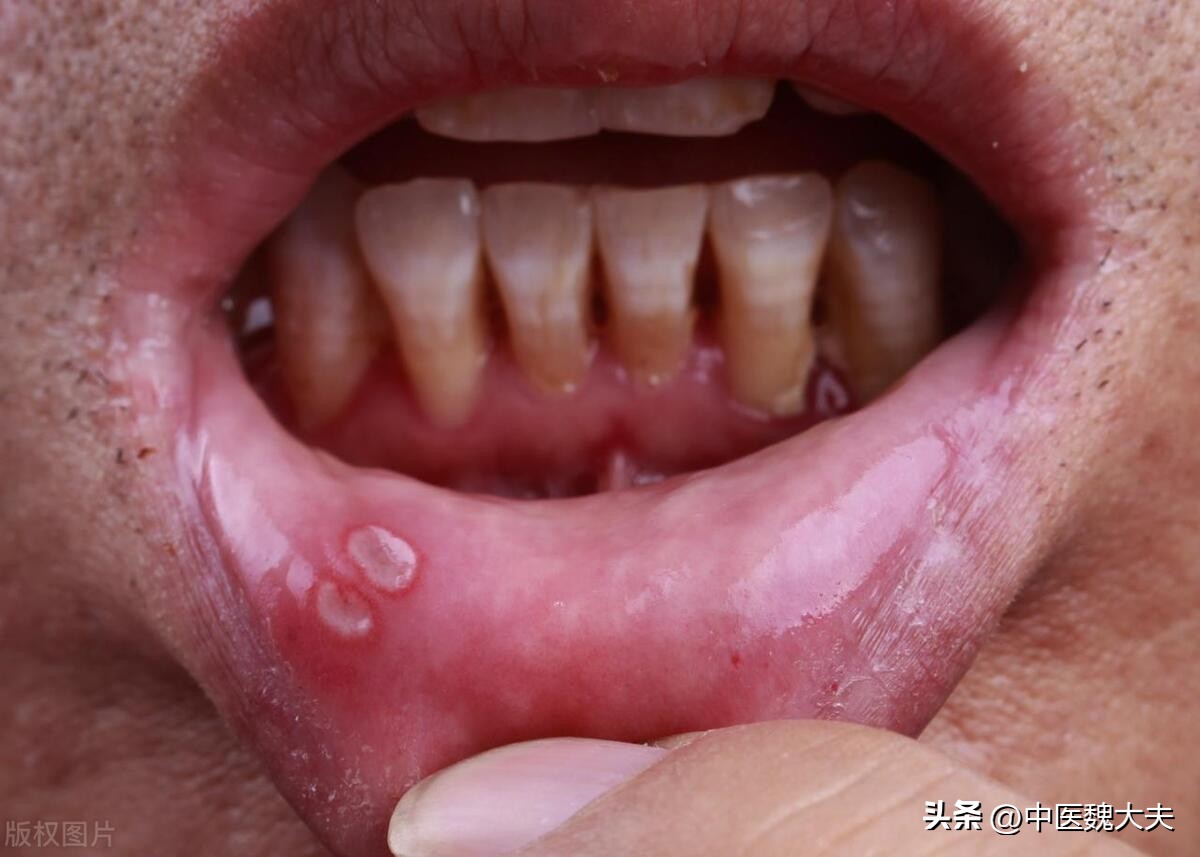 缺乏维生素b的4个信号,身体缺少维生素b2会出现什么症状