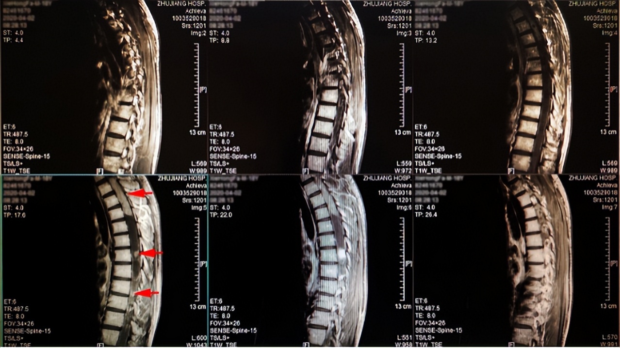 河南22岁女孩体内上千瘤子,22岁女孩体内有1000多个瘤子后续