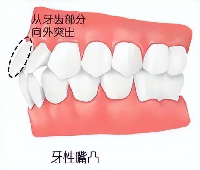 侧脸杀手完整版,侧颌只戴牙套可以矫正吗