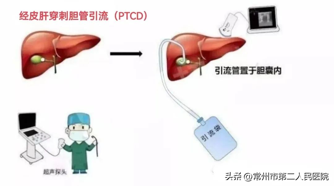 小针孔，用途多，漫画带你了解介入超声能做啥？