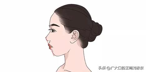 嘴凸要做正畸还是正颌,嘴凸下巴后缩应该正畸还是正颌