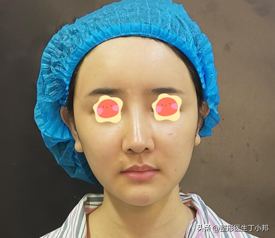 脂肪填充整形知识,脂肪填充修复失败