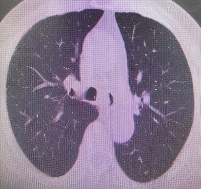 哈医大一院气管镜,哈医大群力呼吸内科