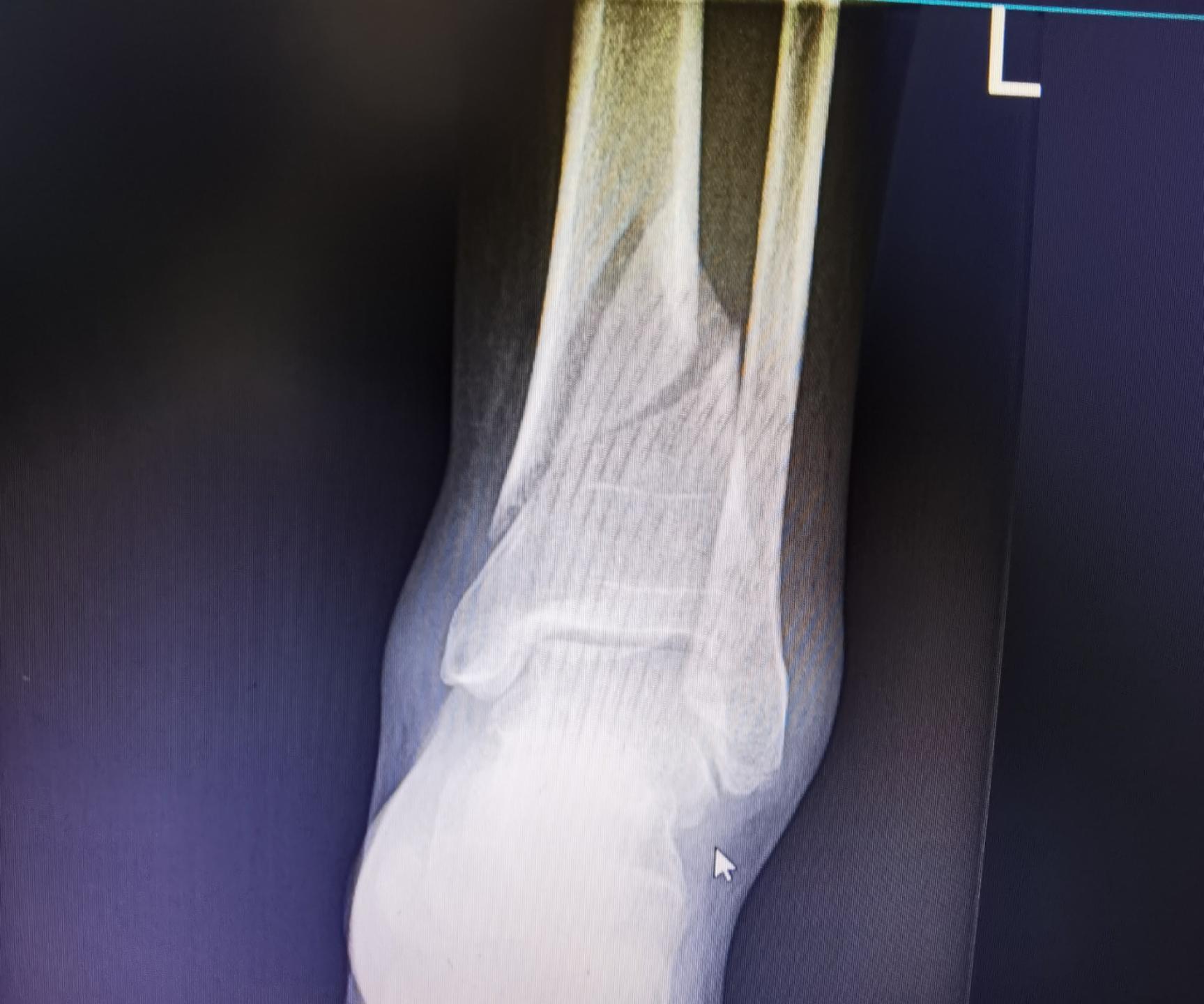 六旬大娘摔倒骨折,七旬老太太下公交车摔伤