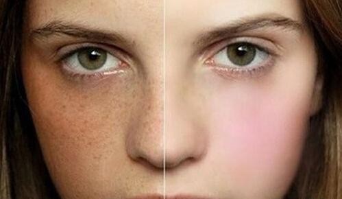 恼人的黄褐斑应该怎么治疗啊,斑中之王怎么消除黄褐斑