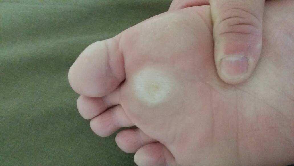 脚底板爱出脚汗怎么回事,脚底板爱紫是什么原因