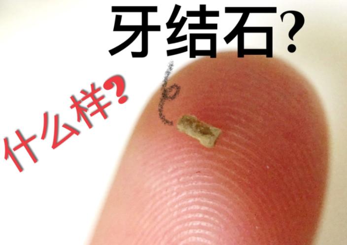 牙结石可以自己抠掉吗,牙结石可以自己抠掉牙根痒怎么办