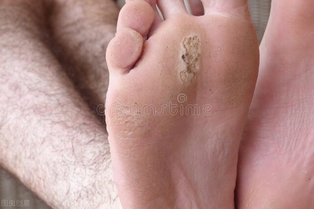 跑步脚丫磨泡了怎么办,跑步脚磨个泡怎么处理