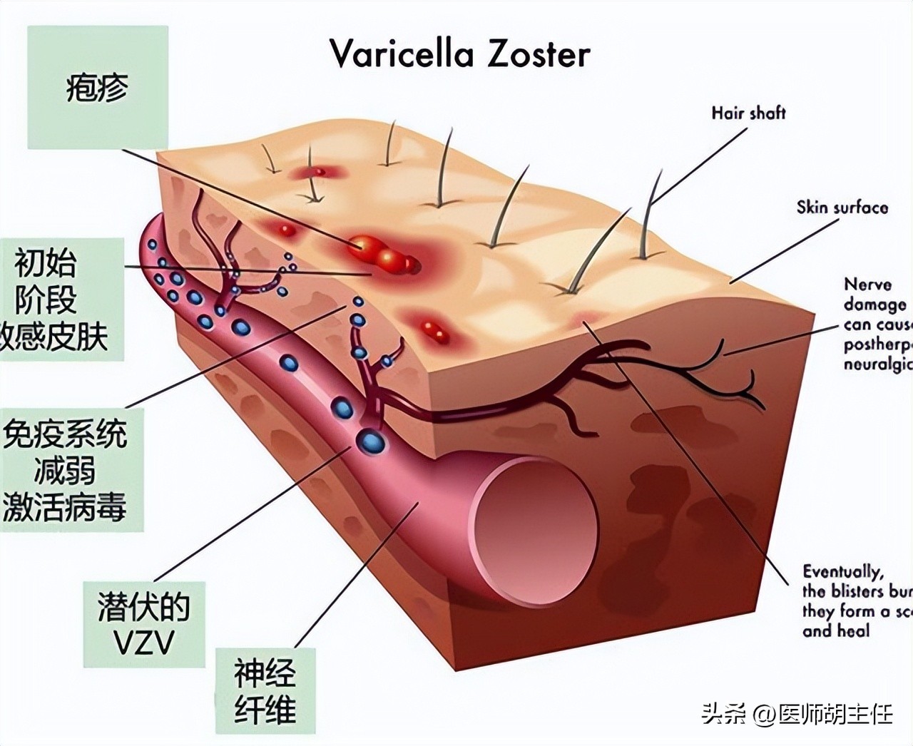 缠腰蛇疱疹干了为什么还很疼,缠腰蛇疱疹什么样