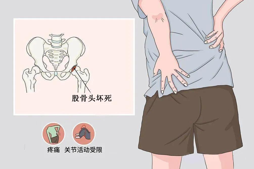治股骨头坏死很好用的一张经方,治疗股骨头坏死很好用的一张经方