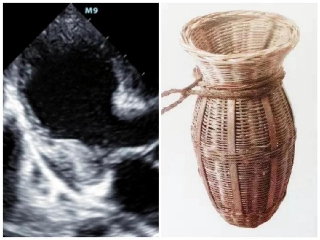 原来伤心过度真的会“心碎”！一文带你了解这种“心碎”的病