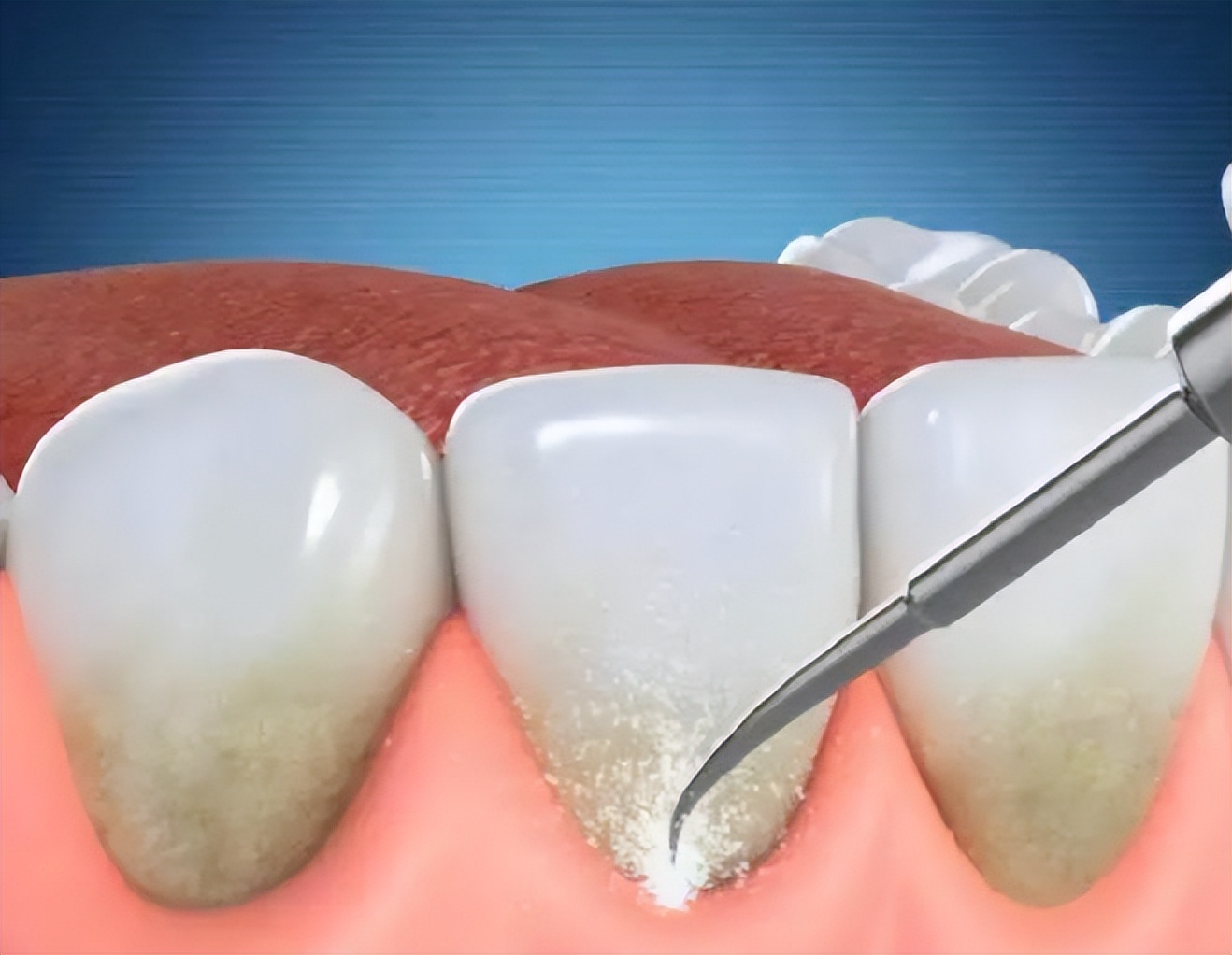 几元钱的甲硝唑能摆平五种病,几元一瓶的甲硝唑或能缓解3种病